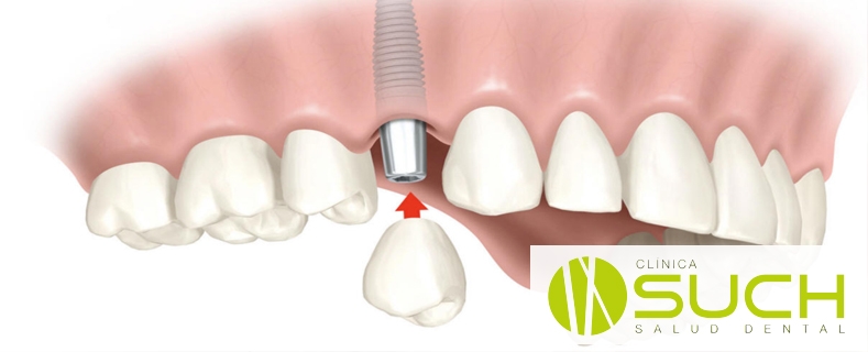 Implantología: ¿Qué hacer cuando nos falta un único diente?