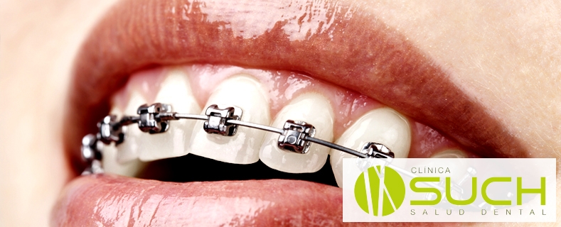 Ortodoncia: ¿Cómo funcionan los brackets?