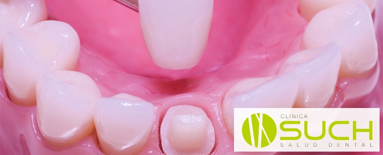 Las coronas dentales para mejorar la estética dental y la sonrisa