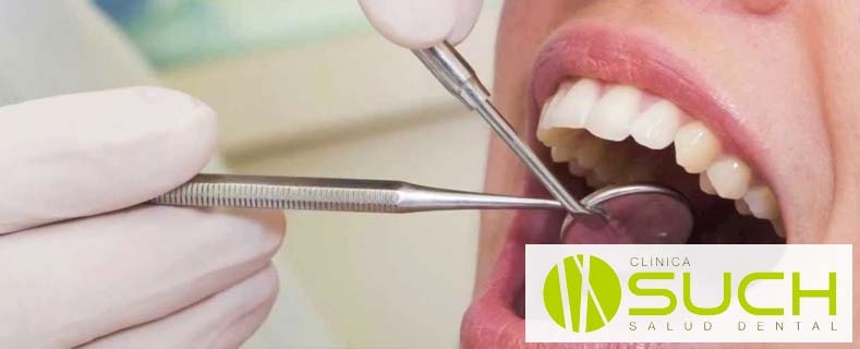 Los empastes dentales: ¿Puedo volver a tener caries en un diente empastado?