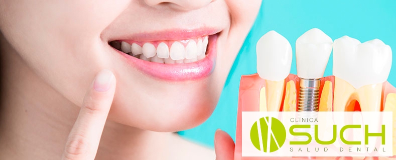 Los implantes dentales mejoran tu calidad de vida
