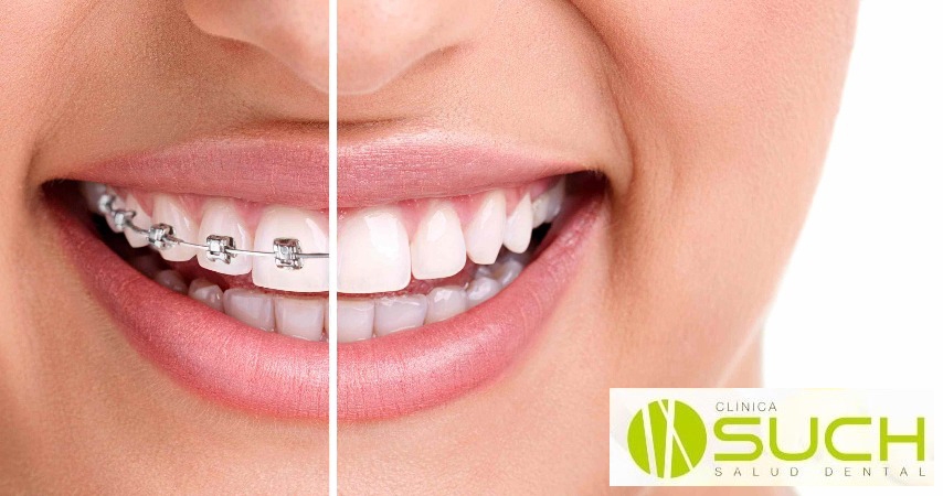La ortodoncia el secreto de una sonrisa perfecta