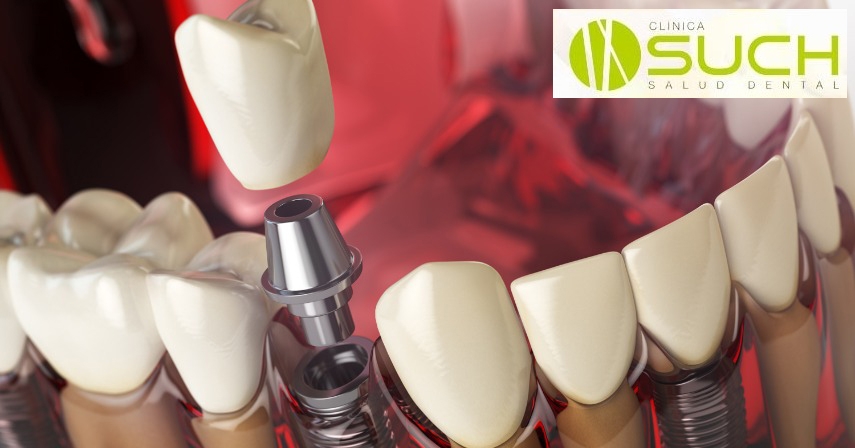 Tipos de implantes dentales ¿Cuál y como es su cirugía?
