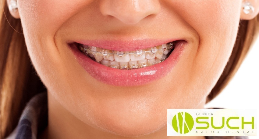 ¿Que es la ortodoncia y como puede ayudarnos? (Parte 3)
