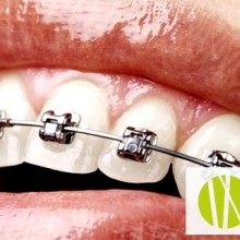 Ortodoncia: ¿Cómo funcionan los brackets?