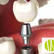 Implantes dentales: ¿Cómo son en su interior?