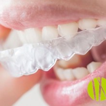 Apiñamiento dental: ¿qué es y por qué ocurre?