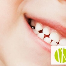 Los dientes de leche: ¿Es aconsejable forzar la caída de los dientes de leche?