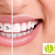 La ortodoncia el secreto de una sonrisa perfecta